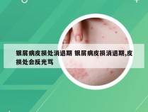 银屑病皮损处消退期 银屑病皮损消退期,皮损处会反光骂