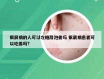 银屑病的人可以吃糖醋泡姜吗 银屑病患者可以吃姜吗?