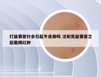 打益赛普针会引起牛皮癣吗 注射完益赛普之后胳膊红肿