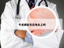 牛皮癣能长在龟头上吗
