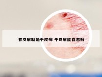 有皮屑就是牛皮癣 牛皮屑能自愈吗