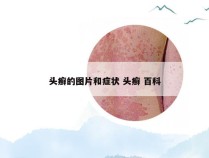 头癣的图片和症状 头癣 百科