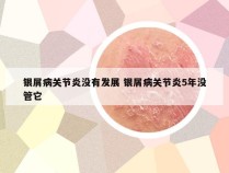 银屑病关节炎没有发展 银屑病关节炎5年没管它