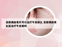 皮肤病血毒片可以治疗牛皮癣么 皮肤病血毒丸能治疗牛皮癣吗