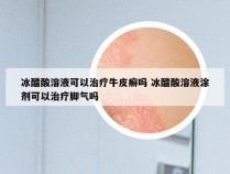 冰醋酸溶液可以治疗牛皮癣吗 冰醋酸溶液涂剂可以治疗脚气吗