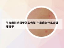 牛皮癣影响指甲怎么恢复 牛皮癣为什么会破坏指甲