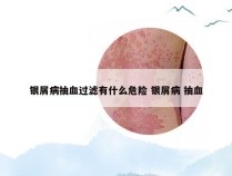 银屑病抽血过滤有什么危险 银屑病 抽血