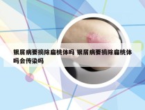 银屑病要摘除扁桃体吗 银屑病要摘除扁桃体吗会传染吗