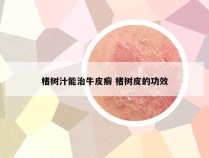 楮树汁能治牛皮癣 楮树皮的功效