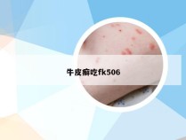 牛皮癣吃fk506