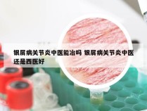 银屑病关节炎中医能冶吗 银屑病关节炎中医还是西医好
