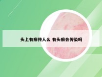 头上有癣传人么 有头癣会传染吗