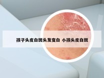 孩子头皮白斑头发变白 小孩头皮白斑