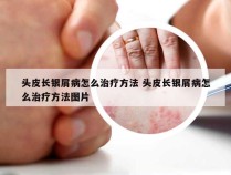 头皮长银屑病怎么治疗方法 头皮长银屑病怎么治疗方法图片