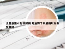 儿童感染引起银屑病 儿童得了银屑病以后会复发吗