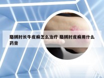 胳膊肘长牛皮癣怎么治疗 胳膊肘皮癣用什么药膏