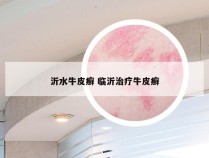沂水牛皮癣 临沂治疗牛皮癣