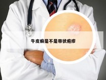 牛皮癣是不是带状疱疹