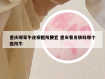 重庆哪家牛皮癣医院便宜 重庆看皮肤科哪个医院牛