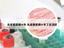 头皮银屑病十年 头皮银屑病十年了还没好