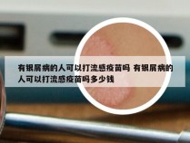 有银屑病的人可以打流感疫苗吗 有银屑病的人可以打流感疫苗吗多少钱