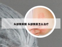 头部银屑图 头部银屑怎么治疗