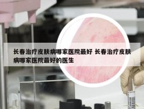 长春治疗皮肤病哪家医院最好 长春治疗皮肤病哪家医院最好的医生