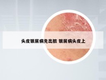 头皮银屑病先出脓 银屑病头皮上