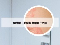 紫根癣丁牛皮癣 紫癣是什么吗