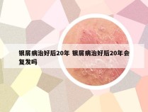 银屑病治好后20年 银屑病治好后20年会复发吗