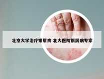 北京大学治疗银屑病 北大医院银屑病专家