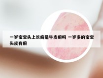一岁宝宝头上长癣是牛皮癣吗 一岁多的宝宝头皮有癣