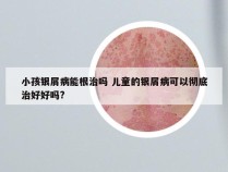 小孩银屑病能根治吗 儿童的银屑病可以彻底治好好吗?