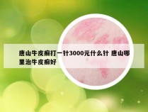 唐山牛皮癣打一针3000元什么针 唐山哪里治牛皮癣好