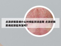 点滴状银屑病什么时候能到消退期 点滴状银屑病皮肤能恢复吗?