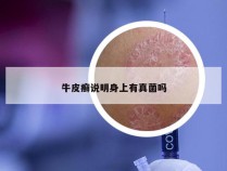 牛皮癣说明身上有真菌吗