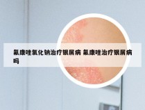 氟康唑氯化钠治疗银屑病 氟康唑治疗银屑病吗