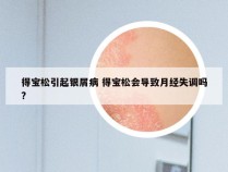 得宝松引起银屑病 得宝松会导致月经失调吗?