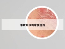 牛皮癣没有家族遗传