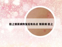 脸上银屑病恢复后有白点 银屑病 脸上