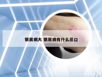 银屑病大 银屑病有什么忌口