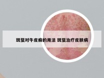 斑蝥对牛皮癣的用法 斑蝥治疗皮肤病