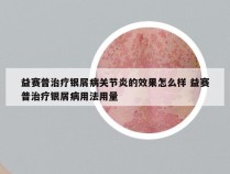 益赛普治疗银屑病关节炎的效果怎么样 益赛普治疗银屑病用法用量