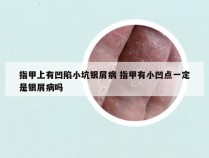 指甲上有凹陷小坑银屑病 指甲有小凹点一定是银屑病吗
