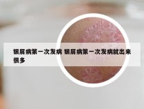 银屑病第一次发病 银屑病第一次发病就出来很多
