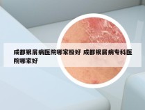 成都银屑病医院哪家极好 成都银屑病专科医院哪家好