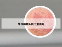 牛皮癣病人能干重活吗