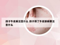 孩子牛皮癣注意什么 孩子得了牛皮肤癣要注意什么