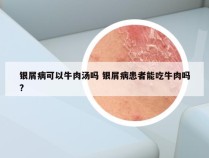 银屑病可以牛肉汤吗 银屑病患者能吃牛肉吗?