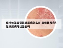 扁桃体发炎引起银屑病怎么办 扁桃体发炎引起银屑病可以治愈吗